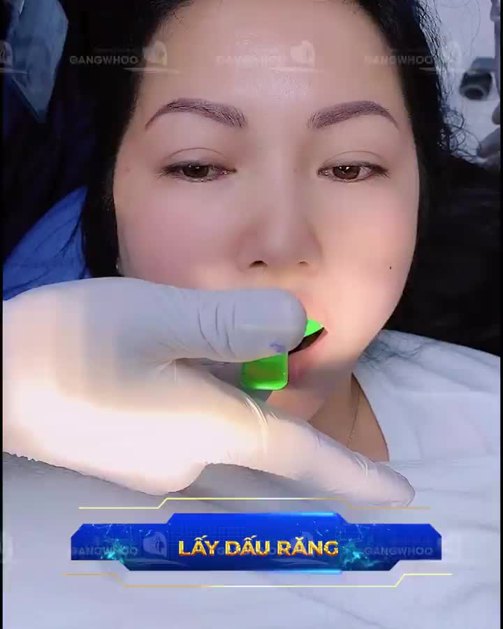 THẨM MỸ RĂNG SỨ TẠI BVTM GANGWHOO CHO BẠN TỰ TIN VỚI NỤ CƯỜI TƯƠI