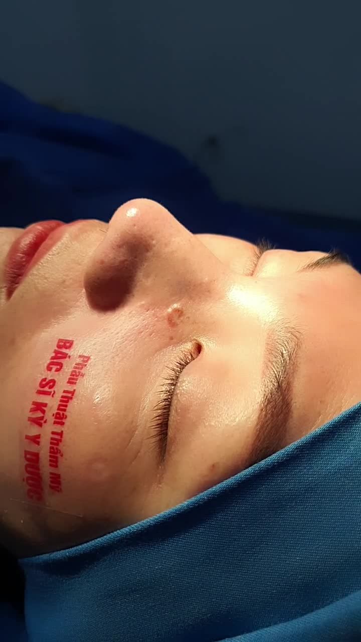 Nâng Mũi BCT 2 Lớp