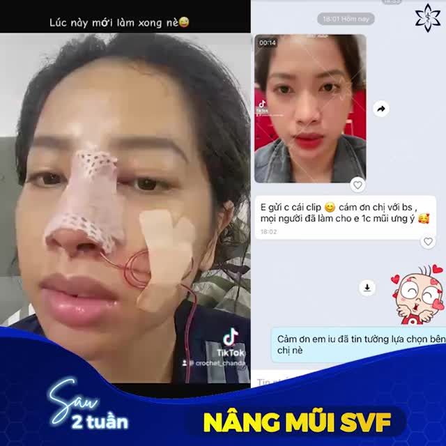 KẾT QUẢ NÂNG MŨI SVF SAU 2 TUẦN