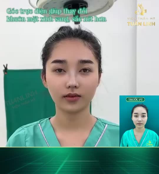 Sở hữu dáng mũi cao bay thanh tú chỉ sau 90 phút phẫu thuật!!