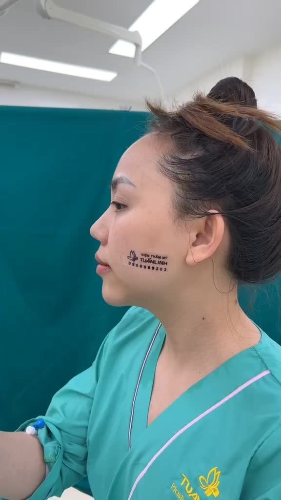 Case độn cằm vừa mới thực hiện xong