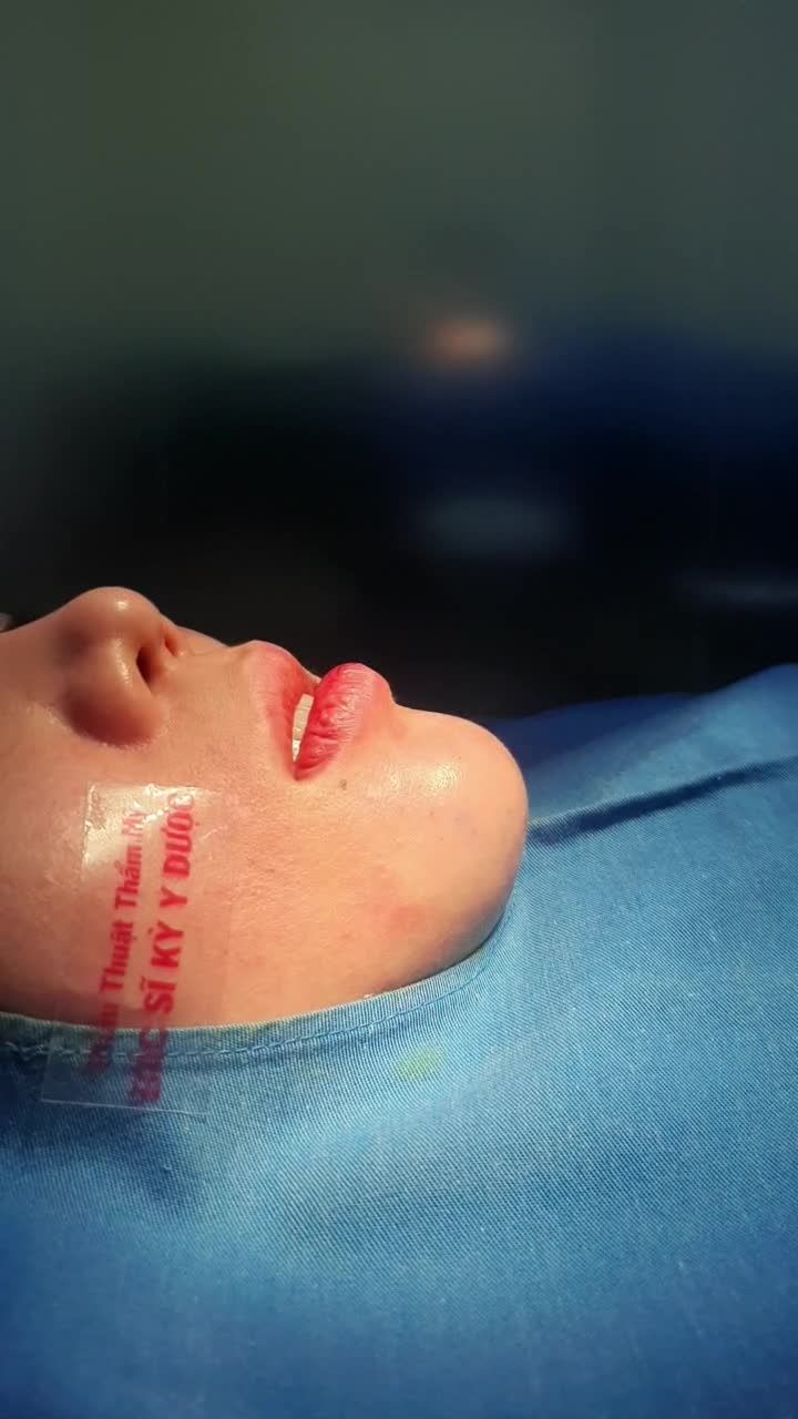 Độn cằm GOLDEN-V - Không để lại sẹo