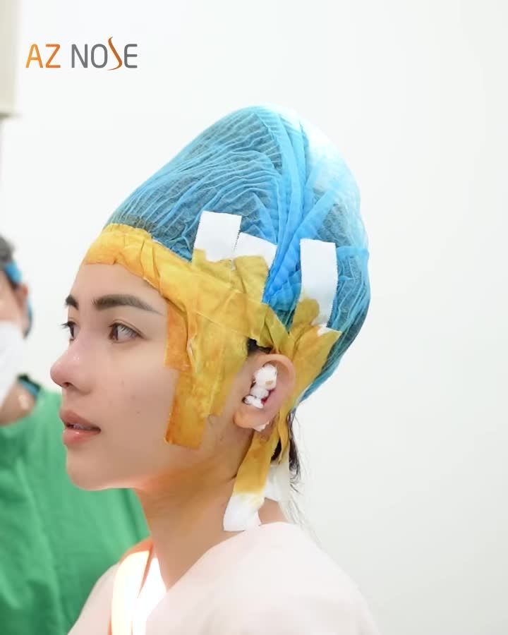 Cần lưu ý những gì khi xem dáng mũi trước khi đóng vết khâu