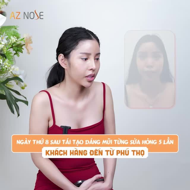 "Khủng hoảng" vì chiếc mũi h.ỏng sau 5 lần phẫu thuật
