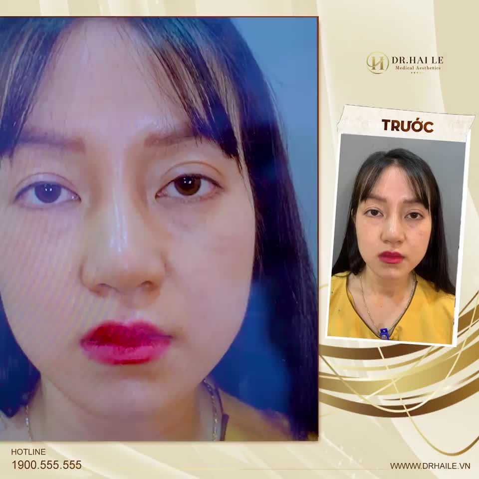 Lấy lại nếp mí đều đẹp, tươi tắn, khắc phục hoàn toàn nhược điểm mắt lỗi hỏng: hai mí không đều nhau, thiếu mỡ, nếp mí to!