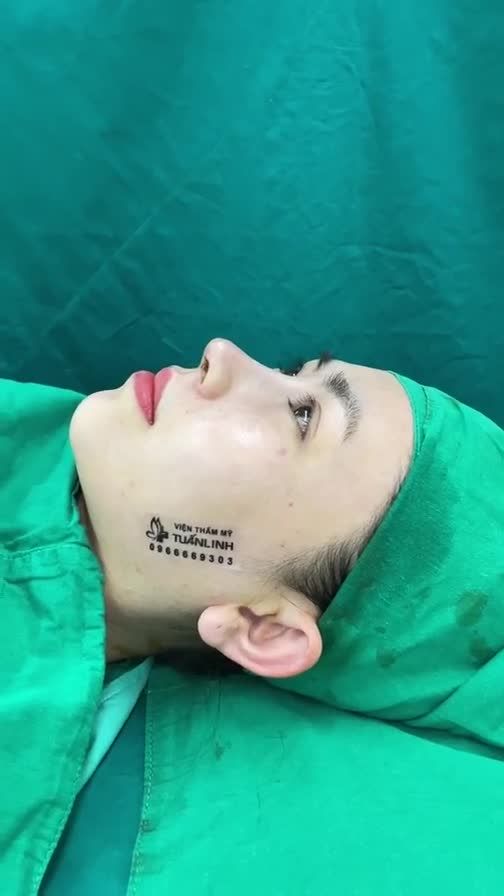 Ca nâng mũi cấu trúc sụn sugrifom vừa hoàn thành cả nhà cùng coi livestream nha!