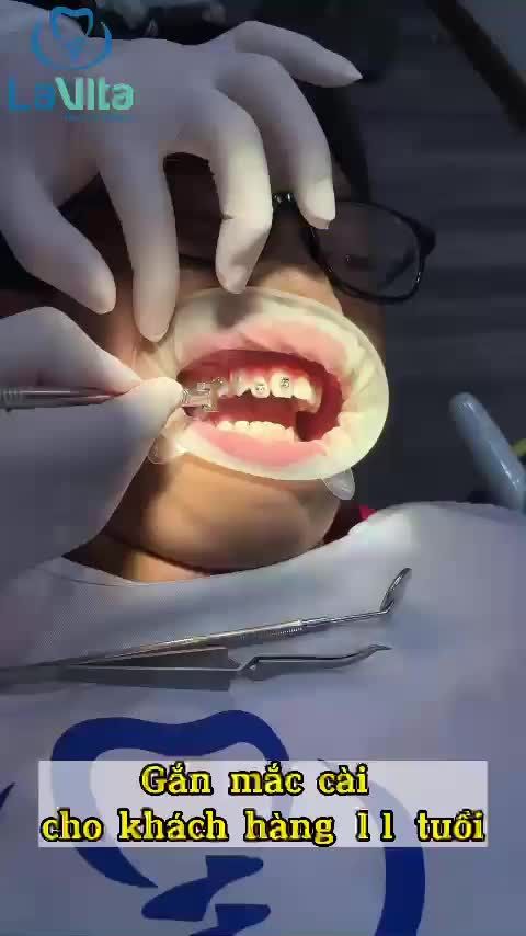 Nắng ấm lên rồi, lịch niềng răng tại Lavita luôn full nên các bạn có nhu cầu chỉnh nha vui lòng đặt lịch trước khi đến để phòng khám không bị quá tải và không phải chờ đợi quá lâu nhé!
