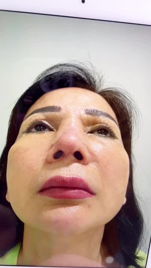 Bác sĩ Tú Dung GIẢI CỨU THÀNH CÔNG chiếc mũi SƯNG PHÙ đầy nghẹt SILICON của Quý cô U60 đến từ USA