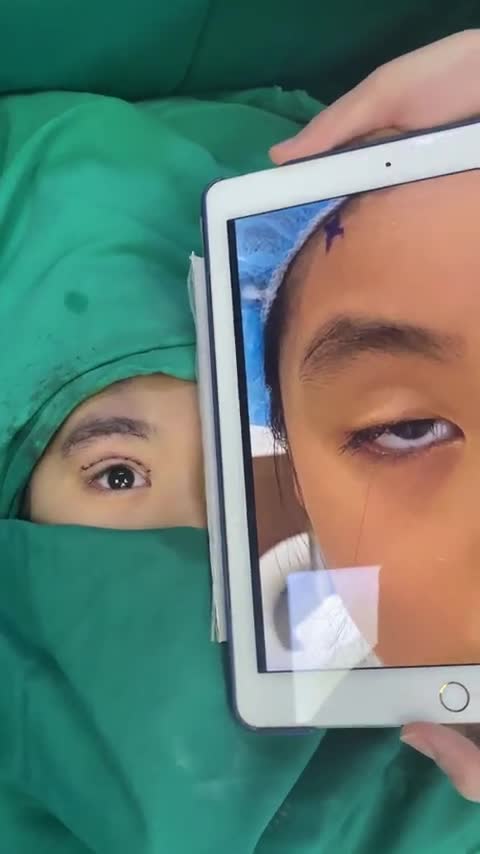 Ca sụp mí bẩm sinh nặng ở trẻ em vừa được thực hiện bởi ekip Dr. Minh Phạm