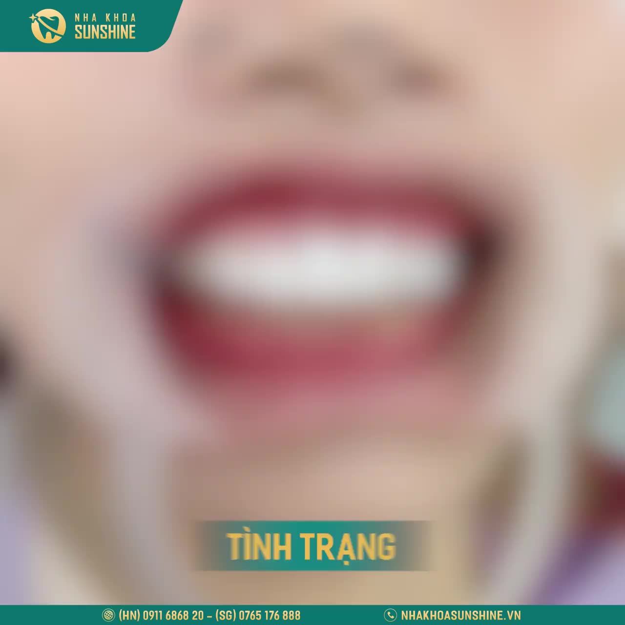 Chị khách hàng NGUYỄN THỊ HIỀN sau một thời gian tự ti về hàm răng đã làm sứ nhưng kết quả không như mong đợi.