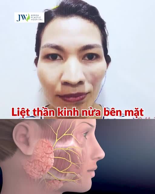 Giải cứu Quý cô LIỆT NỬA MẶT do HỘI CHỨNG ROMBERG bằng phương pháp CẤY MỠ MẶT BABYFACE