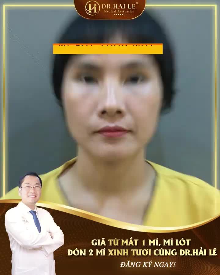 Cắt mí để mắt tươi trẻ, tự tin, thu hút mọi ánh nhìn!