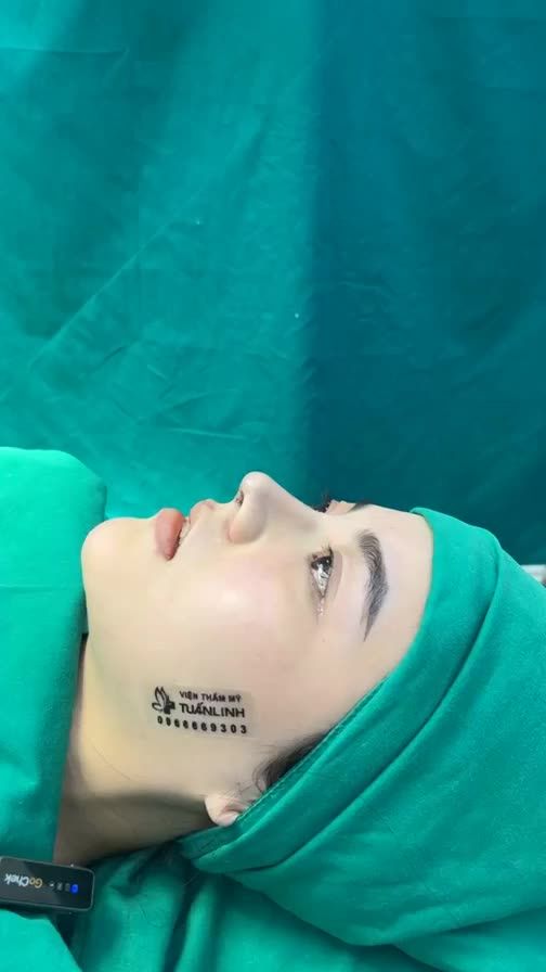 Case mũi cấu trúc vừa hoàn thành