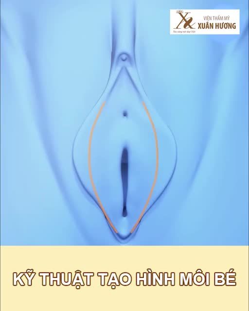 BÁC SĨ SẼ TẠO HÌNH M.ÔI B.É BẰNG CÁCH NÀO?