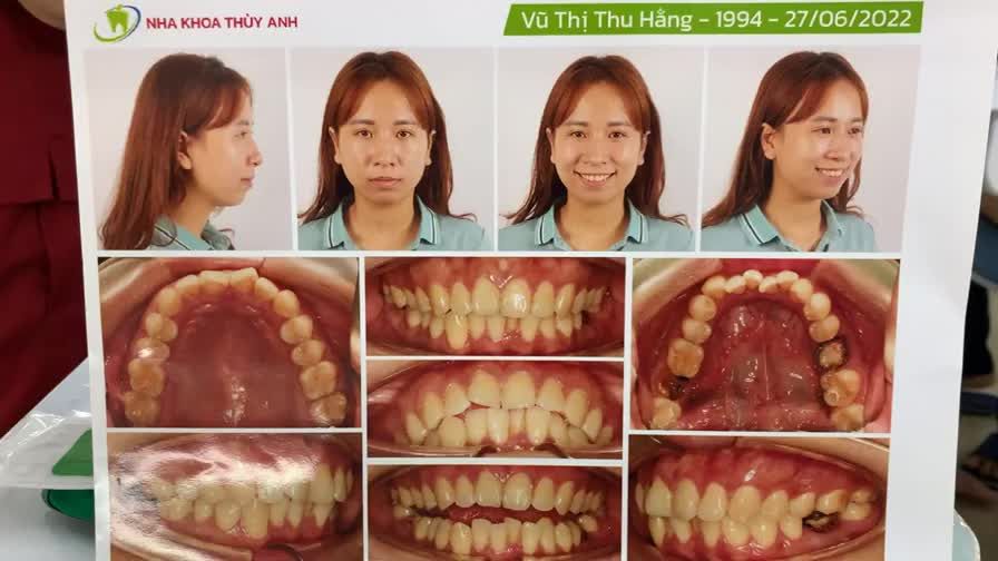 Ca cấy chân răng nhân tạo implant thứ 2 cho khách hàng tại cơ sở tp. Phổ Yên.