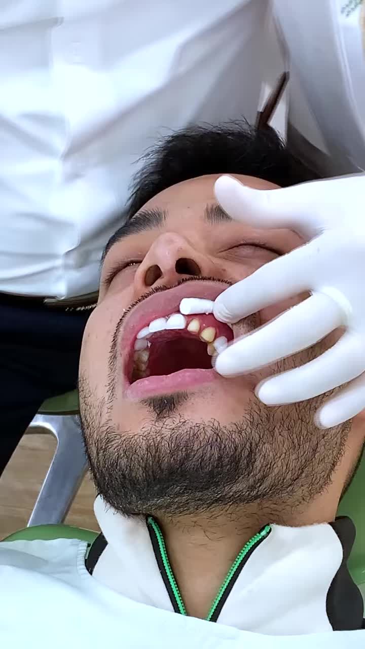 ĐỪNG BỎ QUA QUÁ TRÌNH LẮP RĂNG CHO SIÊU MẪU DANH NGỌC