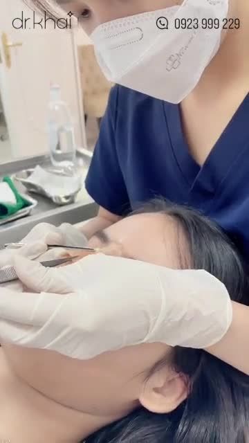 THÁO NẸP SAU 10 NGÀY NÂNG MŨI CẤU TRÚC  GIÂY PHÚT MONG CHỜ CỦA BẤT KỲ KHÁCH HÀNG NÀO