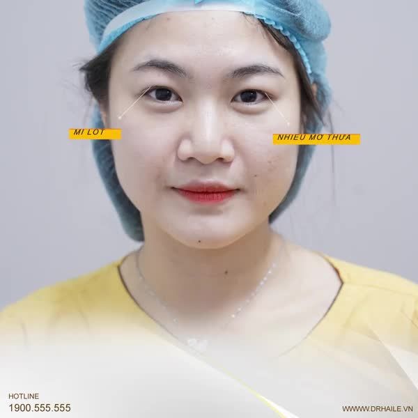 Vị khách hàng trước khi thực hiện Cắt mí cũng từng nghe nhiều lời đồn thổi: "Cắt mí đau đớn", "Cắt mí để lại nhiều biến chứng"...