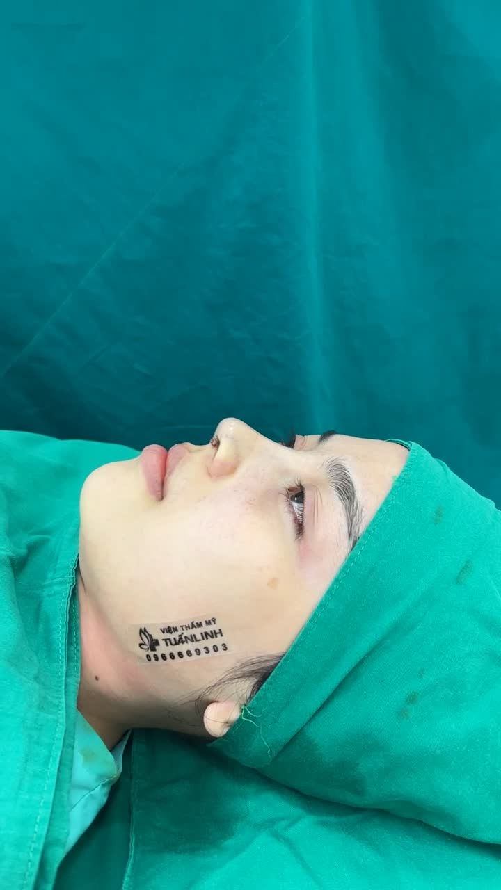 Case mũi cấu trúc vừa mới hoàn thành