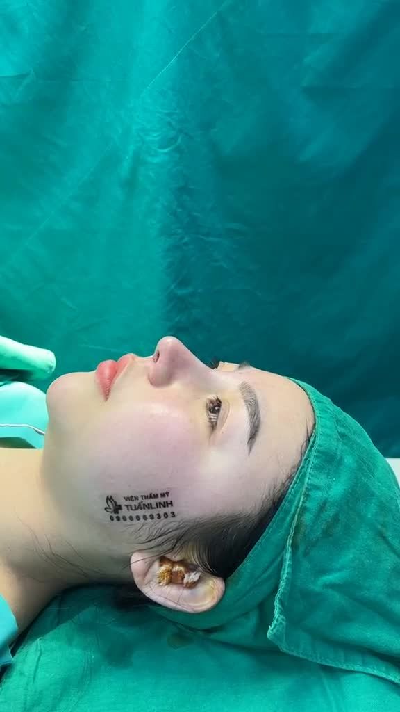 Case mũi cấu trúc vừa hoàn thành