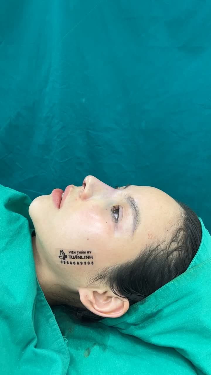 Case mũi Tái cấu trúc vừa hoàn thành