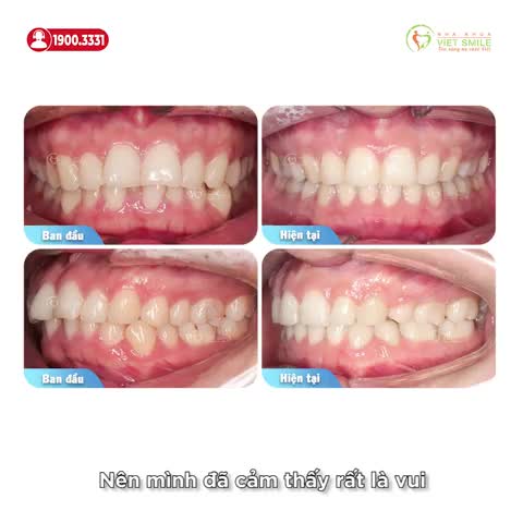 THÁO MẮC CÀI ĐÚNG KẾ HOẠCH - RĂNG HẾT HÔ, KHUÔN MẶT, NỤ CƯỜI ĐẸP