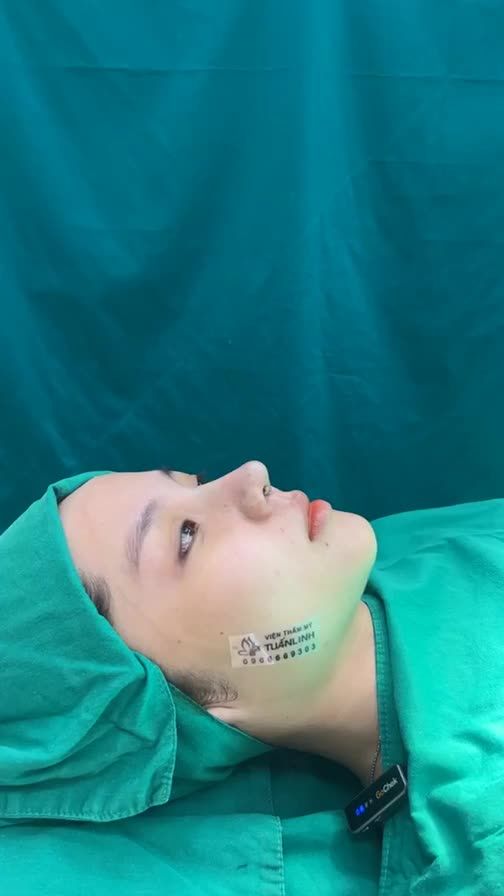 Case mũi cấu trúc sửa lại vừa hoàn thành