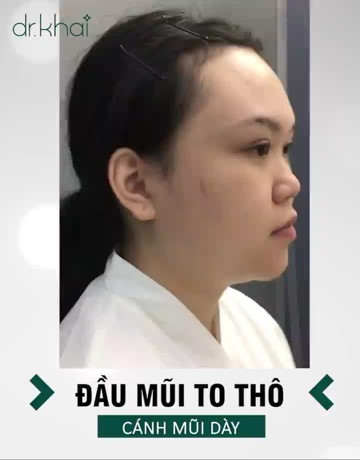NÂNG MŨI CẤU TRÚC - ĐẸP “SIÊU” CUỐN HÚT