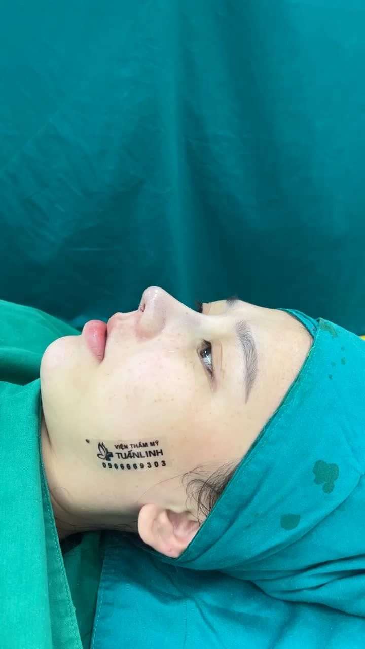 Case mũi cấu trúc vừa hoàn thành