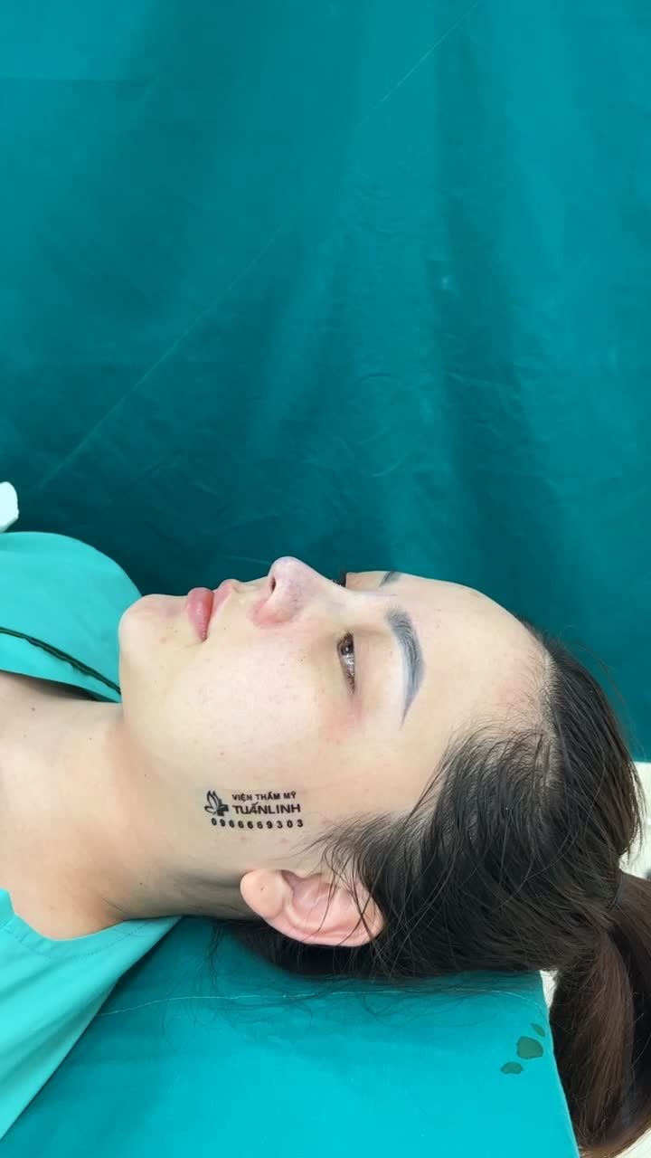 Case mũi bọc sụn vừa mới hoàn thành