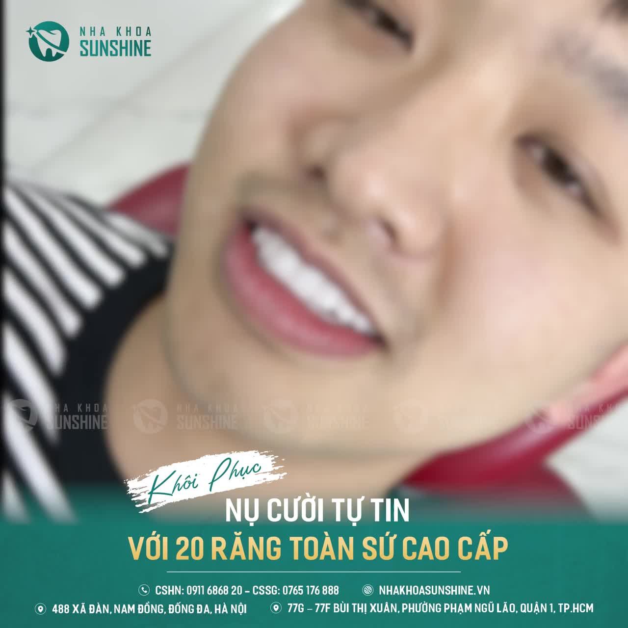 BỌC RĂNG SỨ GIỮ TỐI ĐA RĂNG THẬT - SỰ LỰA CHỌN CỦA NHIỀU VIỆT KIỀU, CA SĨ, DIỄN VIÊN,…