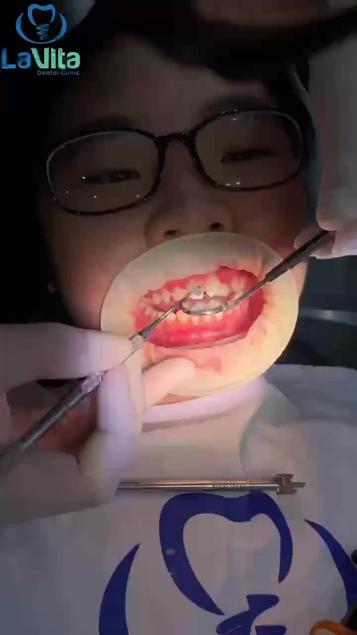 Mùa hè luôn được coi là “thời điểm vàng” trong năm để bắt đầu niềng răng.