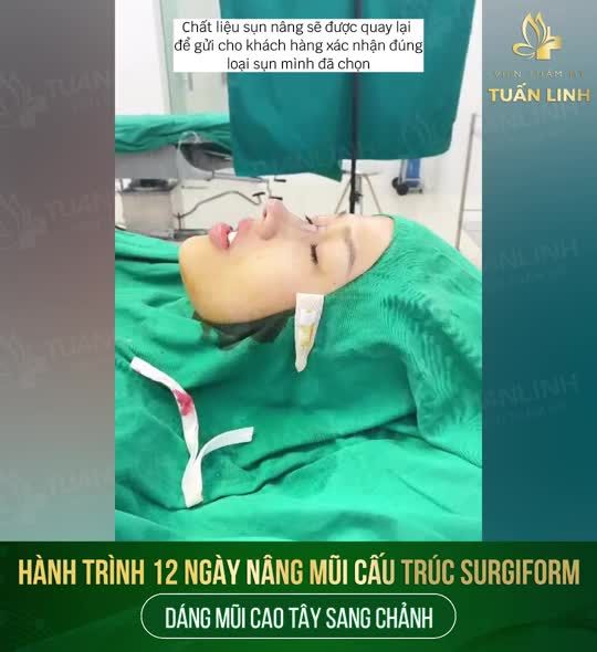 Quá trình thay đổi một chiếc mũi từ thấp tẹt sang cao tây sang chảnh chỉ sau 12 ngày Xem ngay clip bên dưới nha!