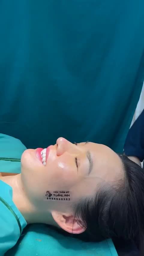 Hoàn thành case Nâng mũi bán cấu trúc cho khách hàng bay về từ ÚC!!