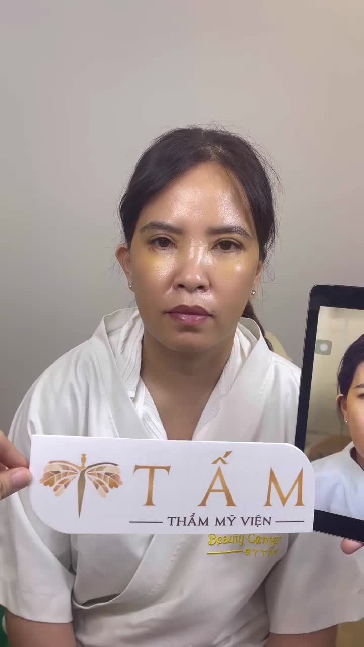 Khách hàng đến tái khám sau làm Nâng cung chân mày tại TMV Tấm.