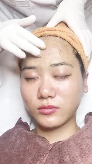 Phương pháp xóa thâm mụn an toàn tại VTM Xuân Hương