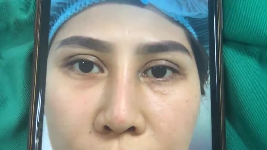 Dr Vương sửa mí trên, sửa góc mắt trong & xoá rãnh lệ sâu mí dưới cho bạn gái đến từ Uông Bí, Quảng Ninh