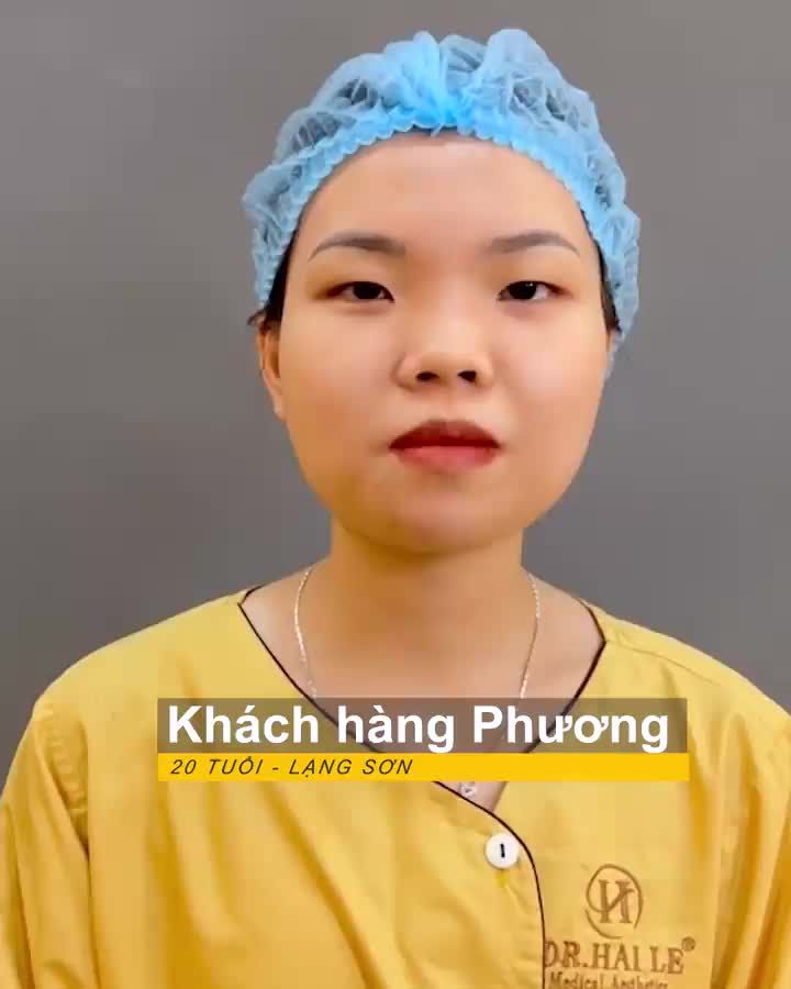 Chỉ 60 phút thực hiện cắt mí, nếp mí sắc nét "lộ diện" ngay tức thì cùng Dr.Hải Lê!