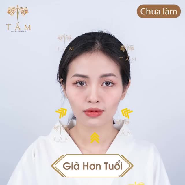 Combo Filler - Đẹp nhẹ nhàng càng tạo sức hút