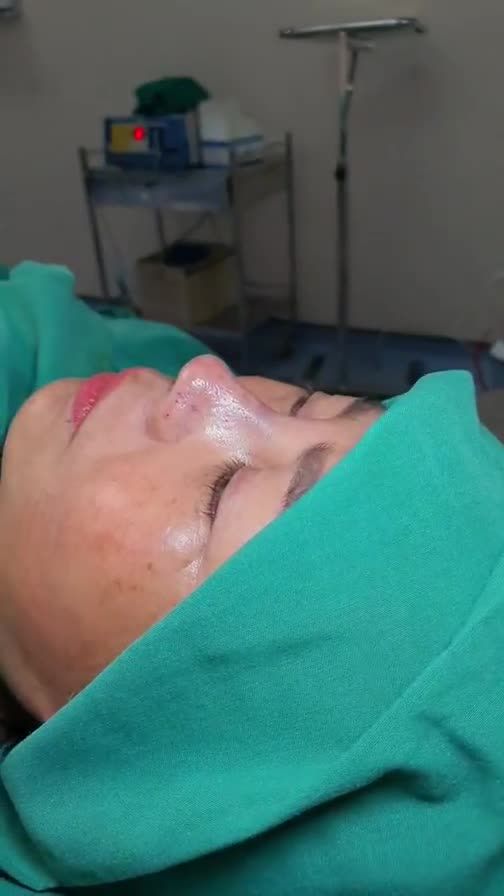 Bác sĩ Kỳ Y Dược vừa mới hoàn thành xong một ca nâng mũi Bán Cấu Trúc 2 Lớp cho một chị Nha Trang