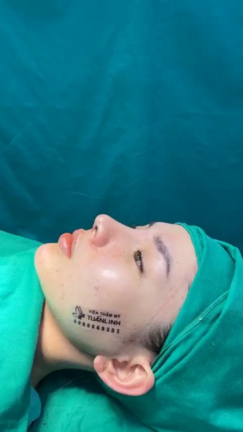 Case mũi cấu trúc vừa hoàn thành