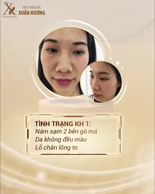 Đúng là trị nám khó vì tế bào Melanocytes sản sinh ra nám ở rất sâu dưới da