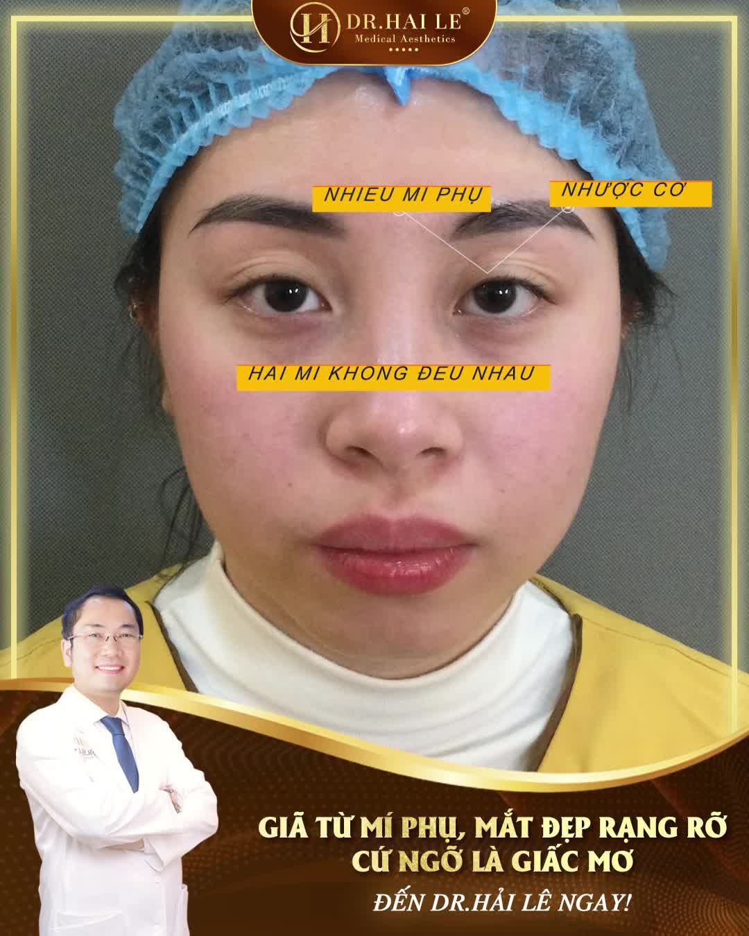 Mong ước sở hữu đôi mắt 2 mí tươi trẻ không hề khó, đã có Dr.Hải Lê!