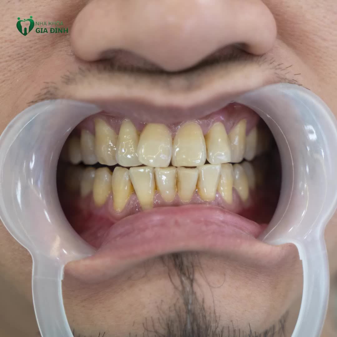 TRƯỚC KHI THẨM MỸ TÌNH TRẠNG RĂNG NHẠC SĨ NGUYỄN ĐỨC CƯỜNG NHƯ THẾ NÀO? TH.S - BS NGUYỄN THẠC HẢI PHÂN TÍCH