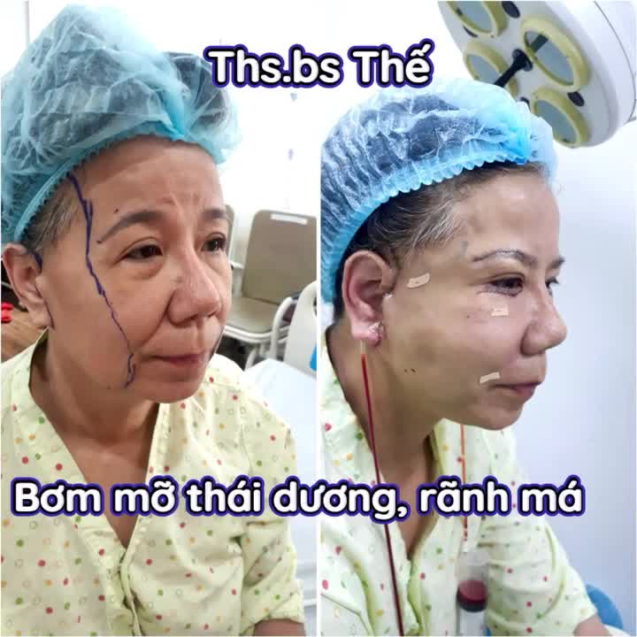 Thay đổi ngạc nhiên sau combo toàn mặt. Chị khách hàng chắc trẻ ra cả chục tuổi