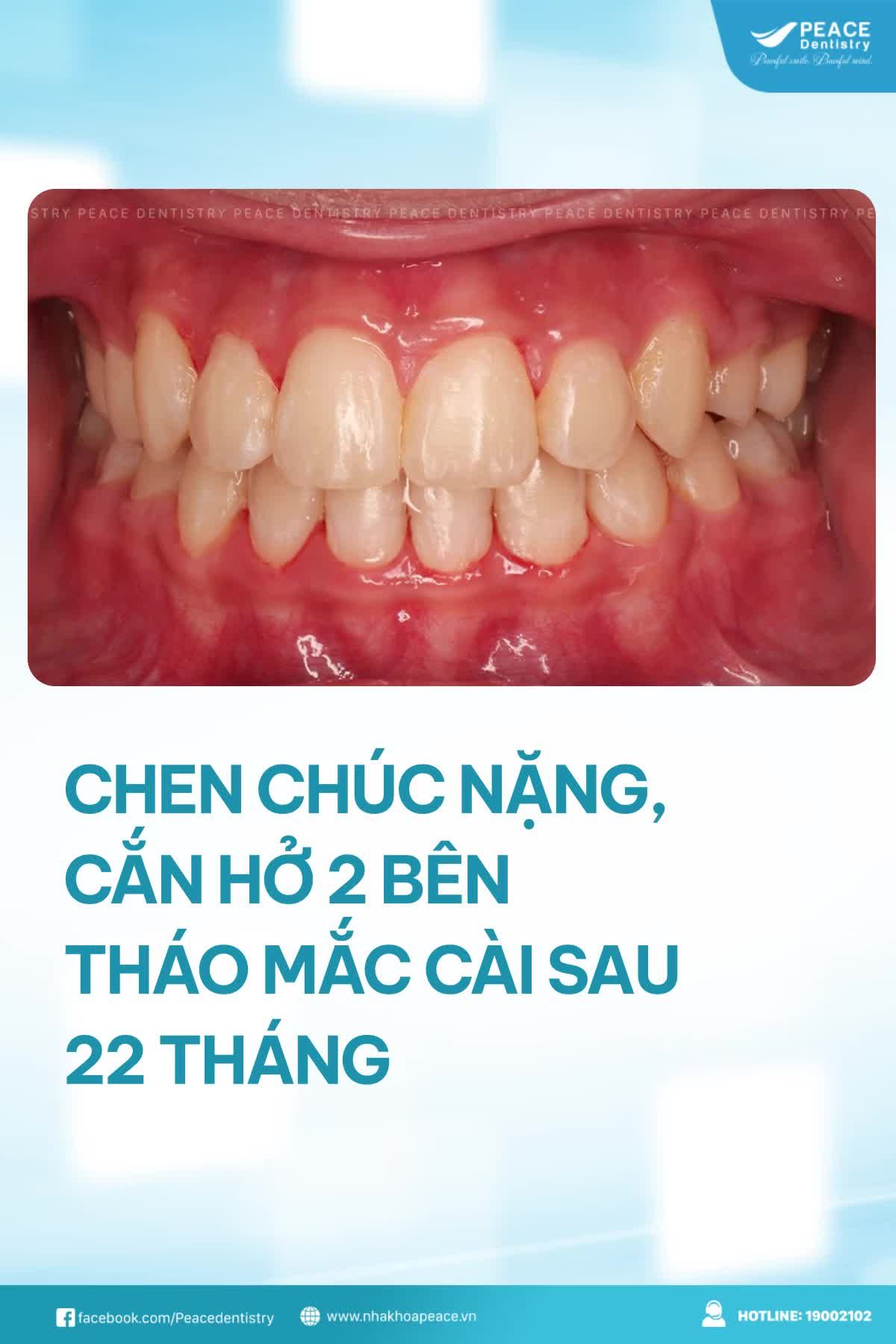 CA LÂM SÀNG NIỀNG RĂNG CHEN CHÚC