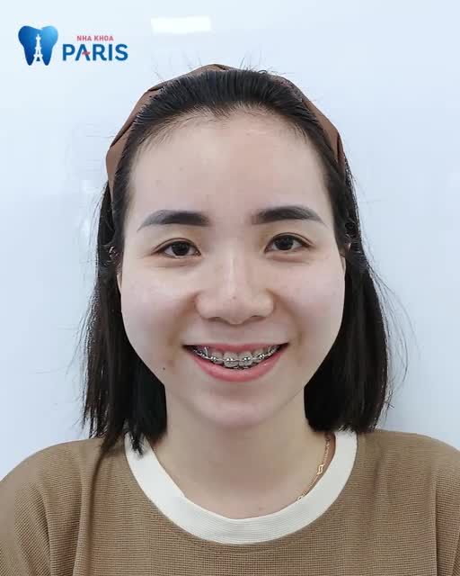 "Lúc niềng răng thì có hồi hộp, có sợ nhưng vì cái đẹp em vượt qua hết" Chị Liên 30 tuổi hoàn toàn sự tin với nụ cười sau 2 năm niềng răng tại nha khoa Paris