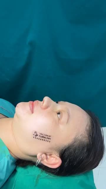 Case Nâng mũi bọc sụn - Dáng mũi nhẹ nhàng, tự nhiên