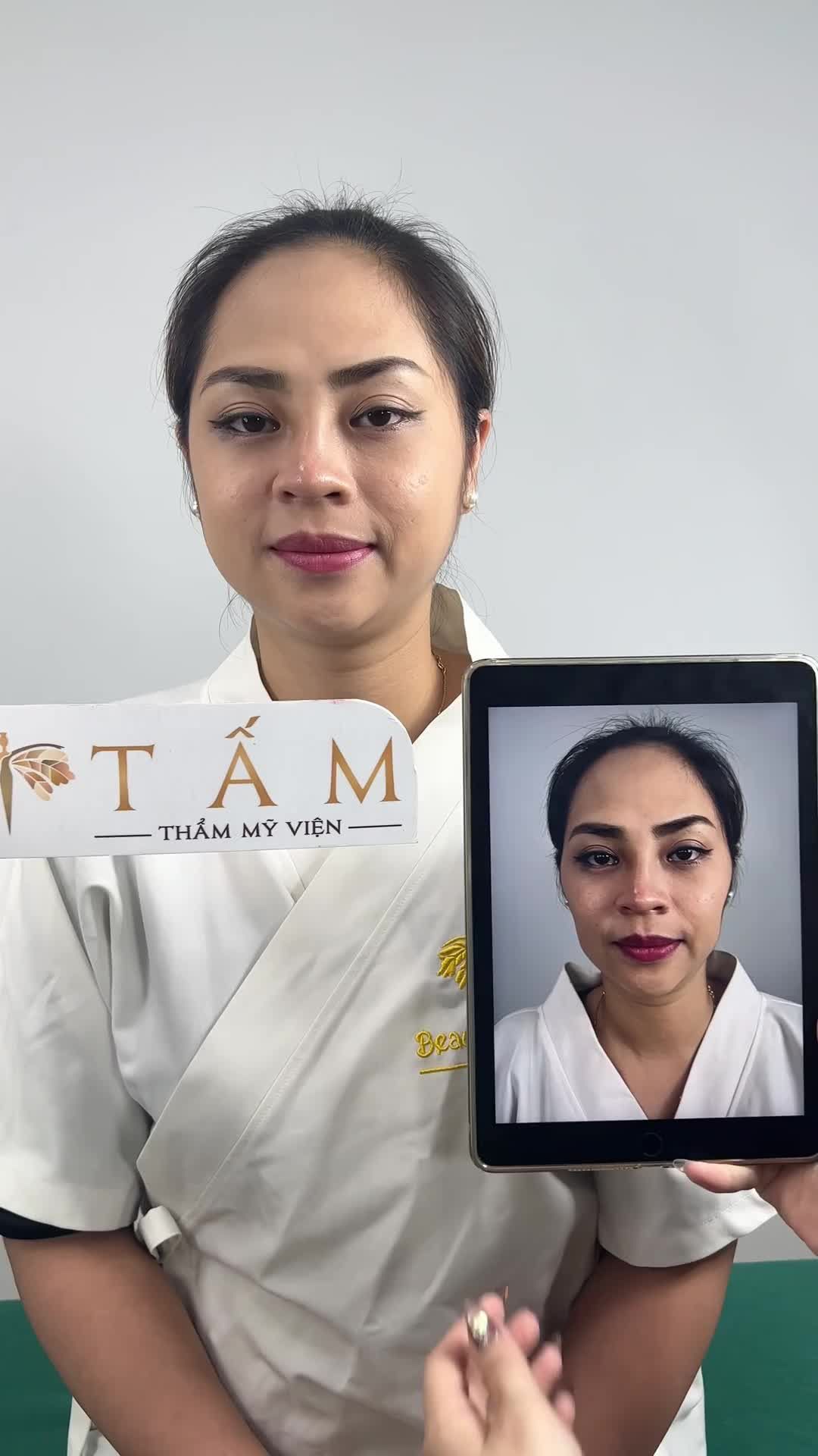 Khác biệt hoàn toàn sau khi sử dụng filler má và thái dương.
