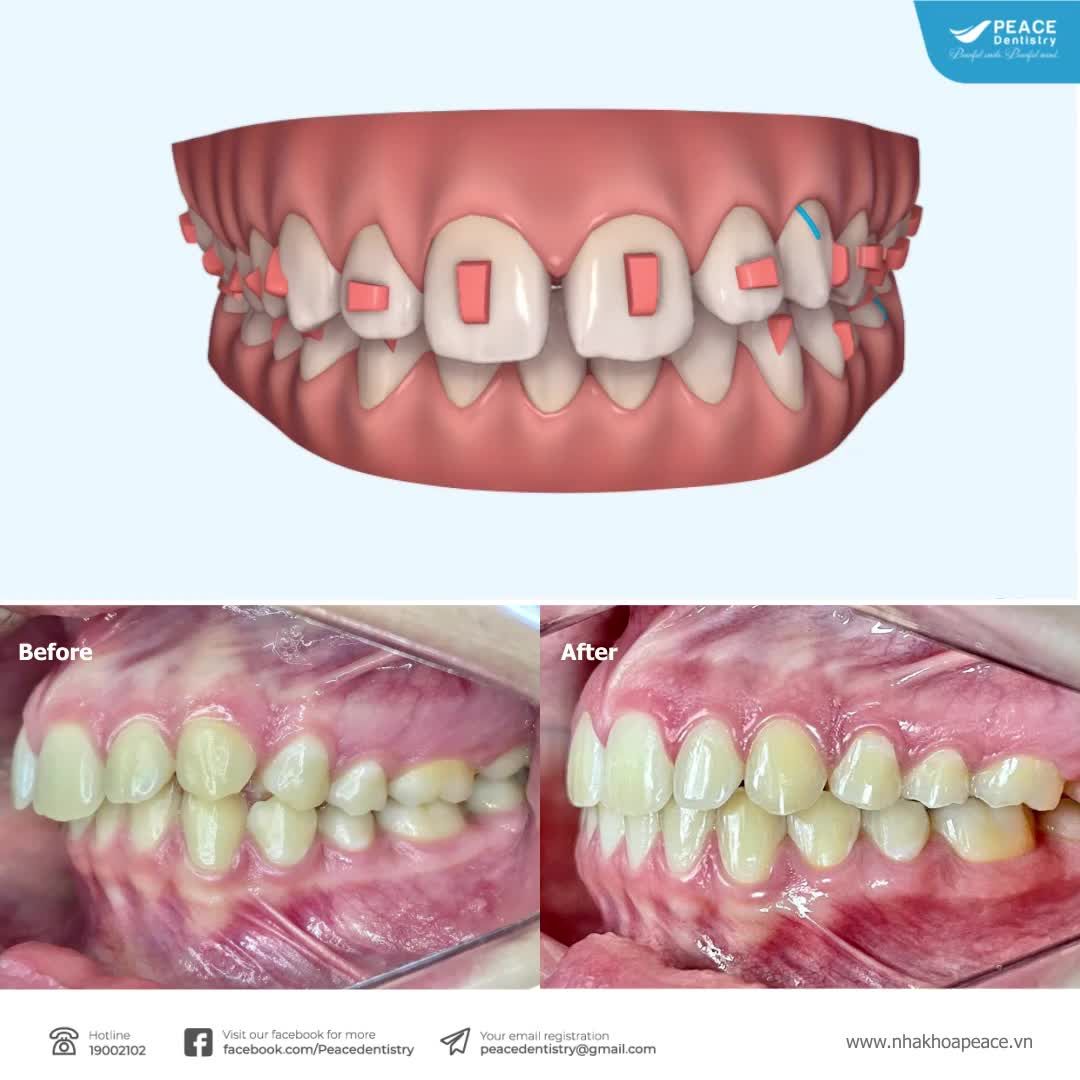 NIỀNG RĂNG HÔ HIỆU QUẢ VỚI KHAY NIỀNG TRONG SUỐT INVISALIGN